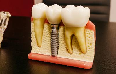 A Comprehensive Guide to Dental Implants in Pasadena