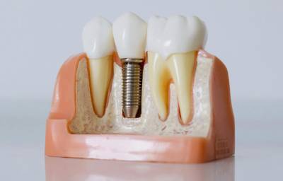 A Step-by-Step Guide to Dental Implants in Pasadena