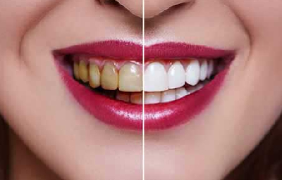 Explore the Top Benefits of Teeth Whitening in Pasadena