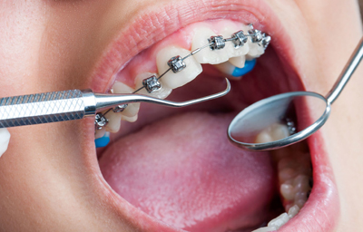 What is Included in Orthodontic Treatment?
