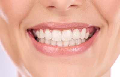 Why Choose a Dental Office for Teeth Whitening in Pasadena?